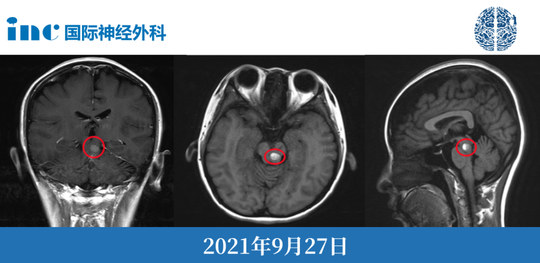 放疗真的可以治疗脑干海绵状血管瘤吗？