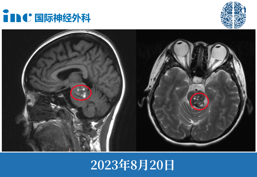 治疗脑干海绵状血管瘤