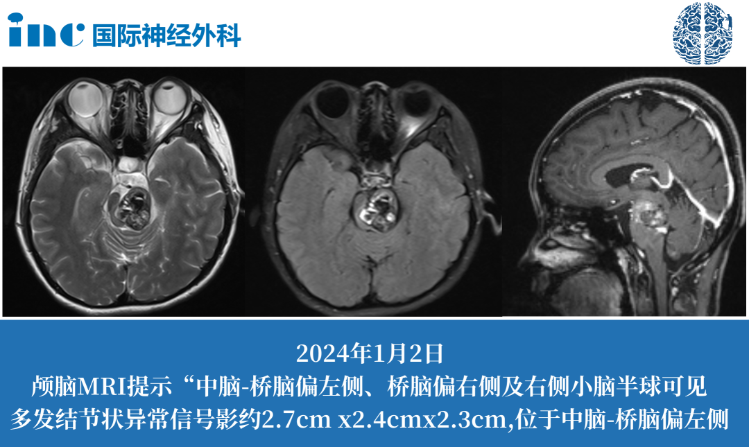治疗脑干海绵状血管瘤