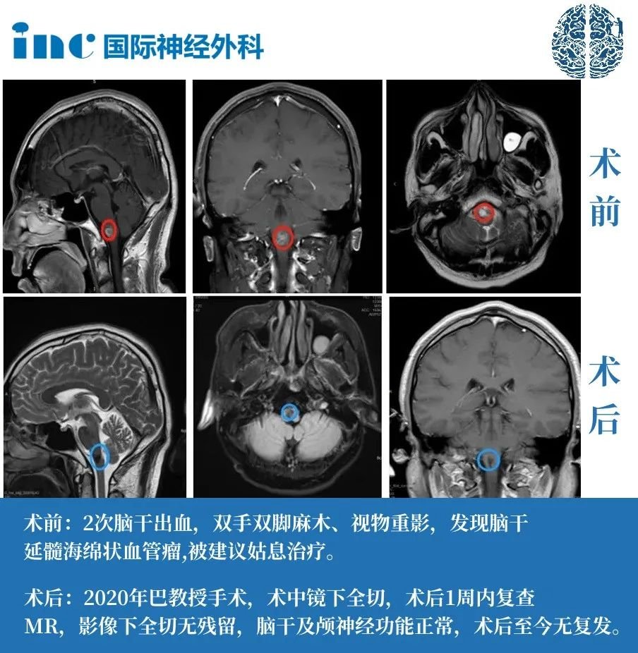 脑干-延髓海绵状血管瘤案例