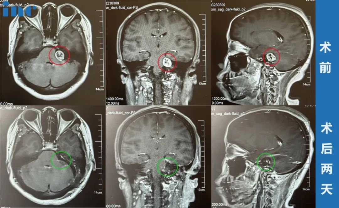 46岁女士——左侧听神经瘤