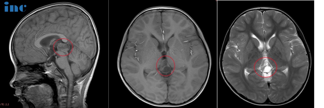6岁男孩——松果体占位性病变