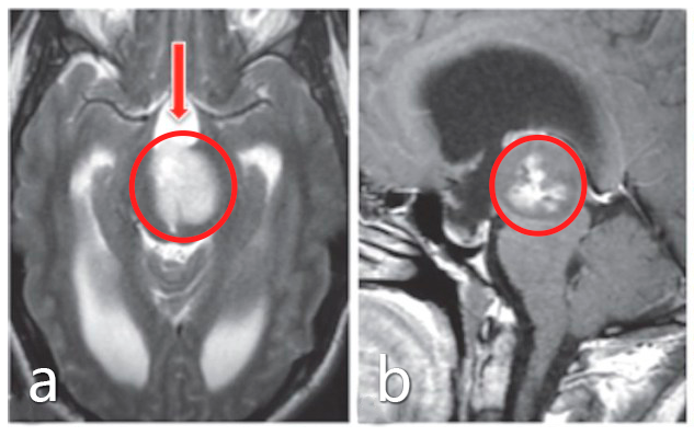 a、b图患者术前MRI影像显示脑干中脑巨大占位，肿瘤占位引起梗阻性脑积水