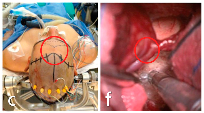 手术入路和体位：额叶正中颅骨切开术，仰卧位。a图箭头指示了额叶半球入路，f图术中照片显示，肿瘤主要通过椎板末端进入，高于保留的前交通动脉。