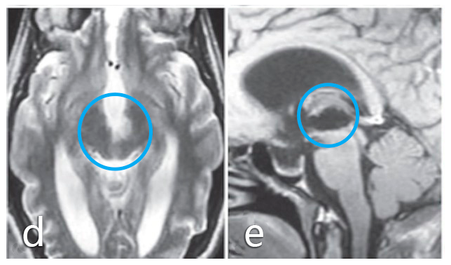 术后：d、e图MRI影像提示肿瘤得到全切，病理结果为1级毛细胞型星形细胞瘤。无围手术期并发症，无神经和认知缺陷，术后5年随访未见复发。