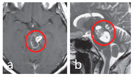 术前：a、b图患者术前MRI显示中<a href='/qianyan/naozhongliu/' target='_blank'><u>脑肿瘤</u></a>，患者最初接受立体定向囊肿抽吸和间质放疗，并被诊断为毛细胞型星形细胞瘤，但肿瘤仍在生长。