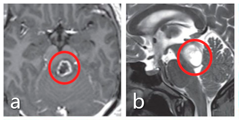 a、b图术前MRI显示脑干中脑占位，肿瘤导致导水管闭塞。