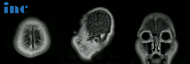 术前MRI