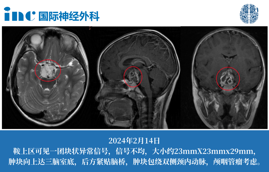 7岁男孩-鞍上区囊实性占位疑似颅咽管瘤——案例