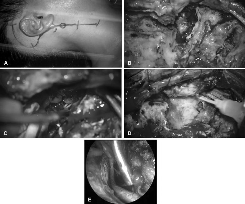 图2，外科手术的步骤。(A)沿胸锁乳突肌前缘切口，穿过乳突上方。(B)切除钻取枕髁和乳突后的肿瘤包膜视图。(C)从对侧颈静脉孔的神经进行硬膜内肿瘤剥离。(D)使用游离脂肪移植物闭合硬膜缺损。(E)内镜硬膜内探查显示对侧颈静脉孔有肿瘤残留，需要继续进行肿瘤切除。