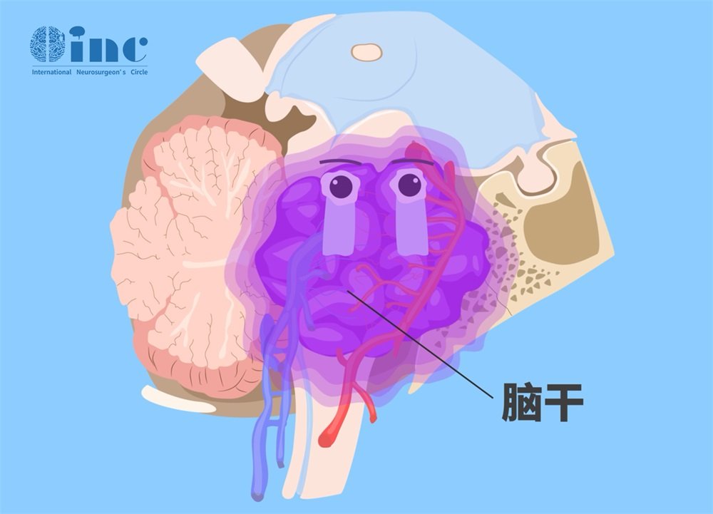 胶质瘤靠近脑干能做手术吗？