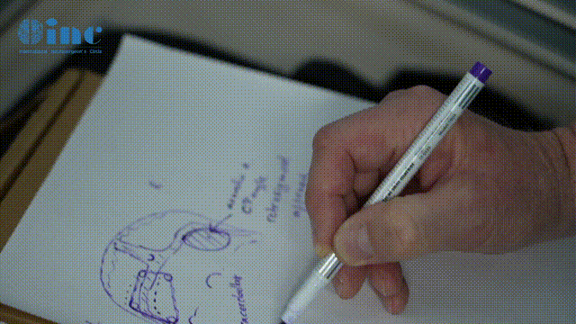 术前手绘手术切口及手术入路，和国内神经外科团队详细解释手术方案