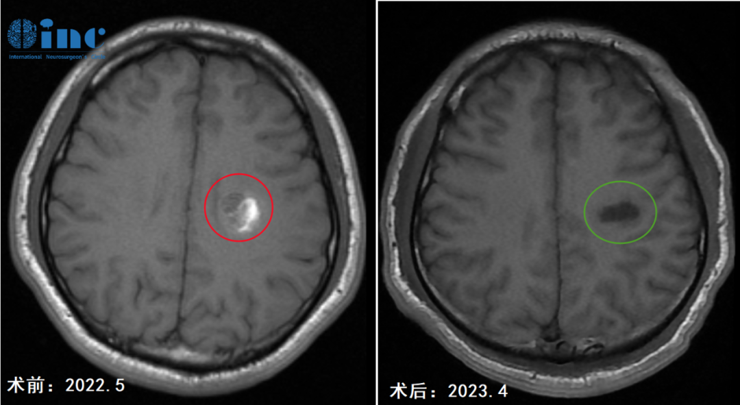 术前术后MRI影像对比