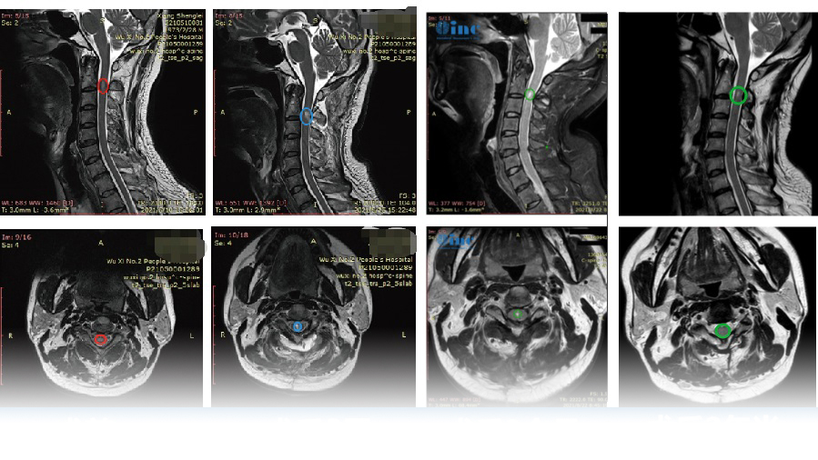 脊髓髓内肿瘤真实成功案例——术前