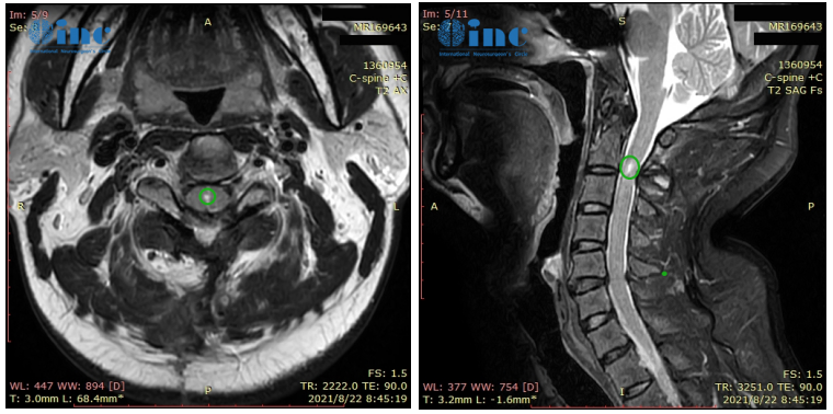 术后3个月回访：
