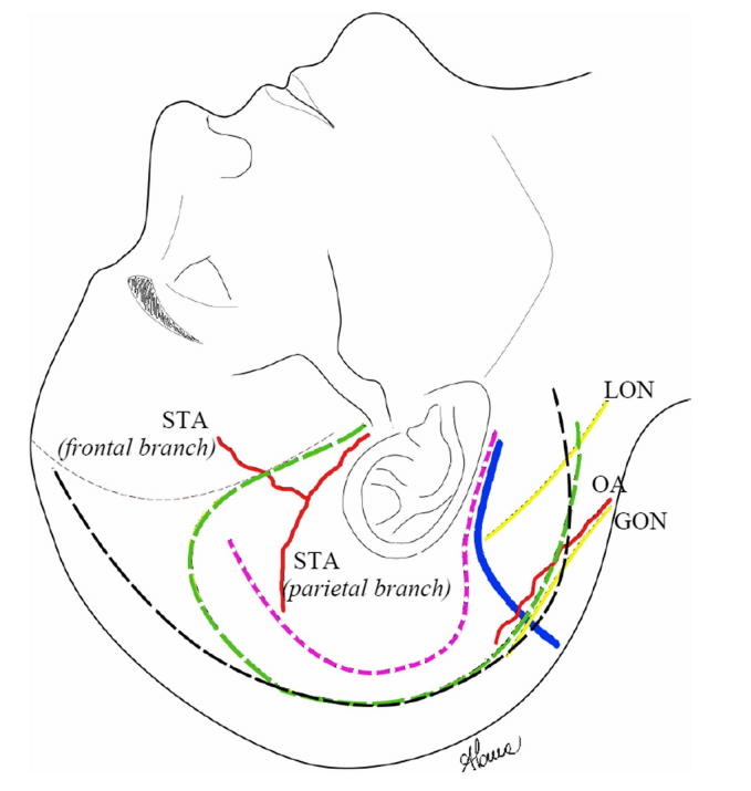 mini联合经岩骨入路的头皮切口（粉色虚线）和整体示意图，注意左图OA（枕动脉）走行有误