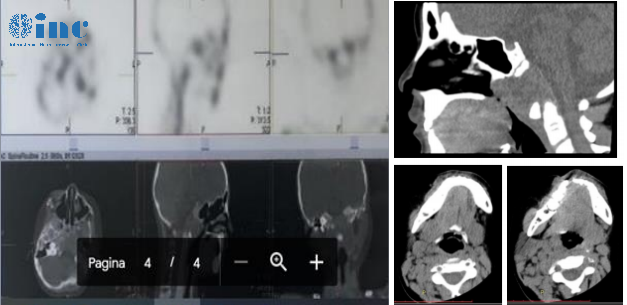 INC法国福洛里希教授、巴特朗菲教授等三位来自INC国际神经外科医生集团的外籍专家，通过远程咨询，对患儿病情进行评估后提出建议