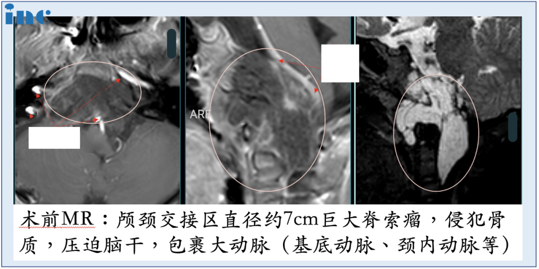 6岁男孩-较大脊索瘤压迫脑干  　　4年内3次手术，多次复发，从未放弃生存希望