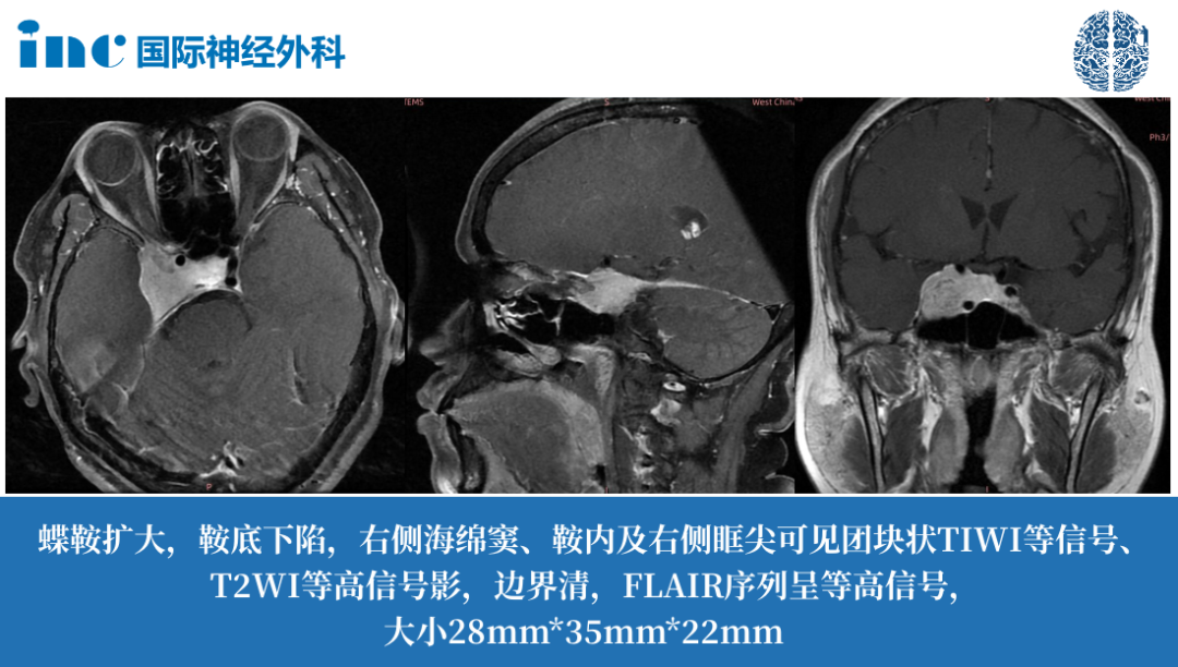 48岁男性-右侧海绵窦、鞍内及右侧眶尖脑膜瘤  　　视力下降、突然发胖