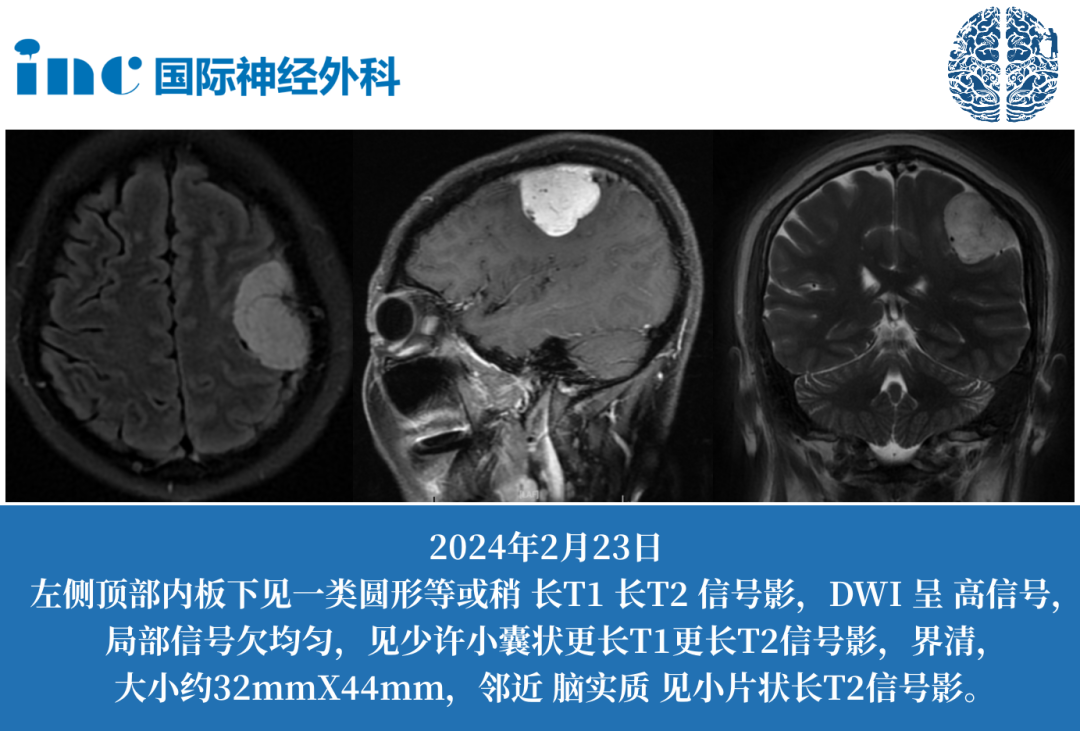 51岁女性-额叶脑膜瘤  　　如果巴教授做手术，能否全切？