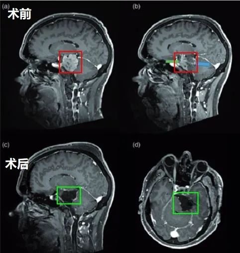 53岁男性高难度岩斜区脑膜瘤