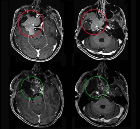 53岁男性累及海绵窦和Meckel's腔的脑膜瘤