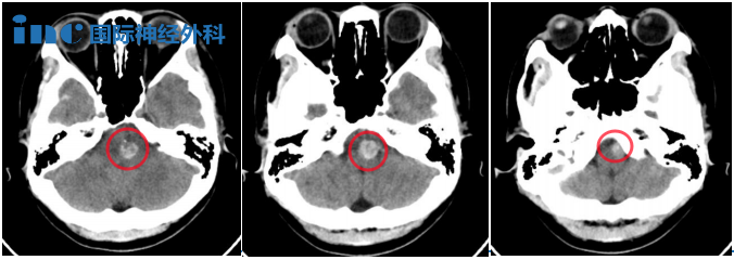 28岁高难度脑干延髓海绵状血管瘤真实案例CT