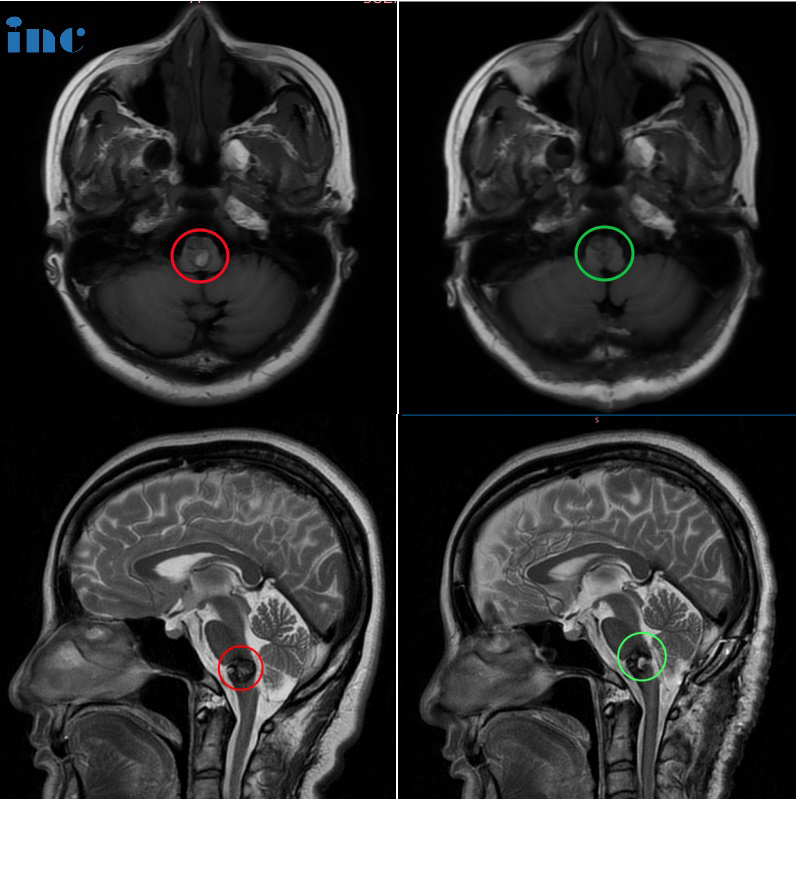 50岁女性-延髓海绵状血管瘤案例影像