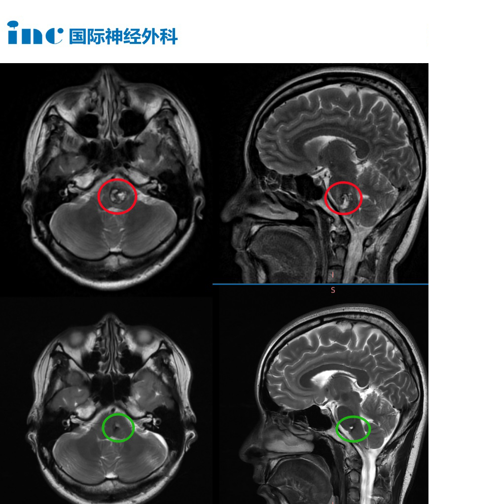 28岁女性-脑干延髓海绵状血管瘤案例影像