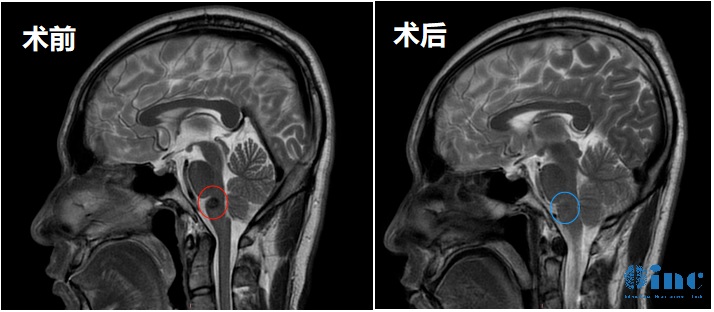 32岁男性-延髓海绵状血管瘤案例影像