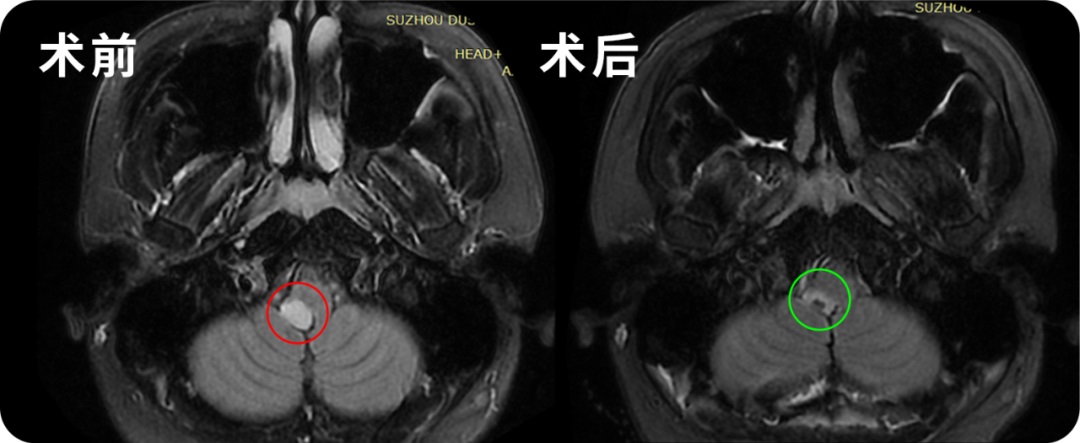 24岁男性-脑干延髓低级别胶质瘤图片