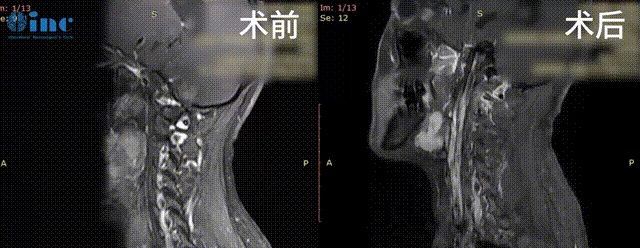 33岁女性-脑干颈髓室管膜瘤