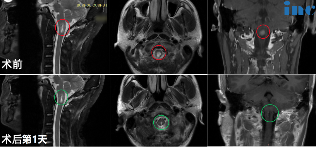 34岁男性-脑干延髓-颈髓室管膜瘤WHO2级影像图片