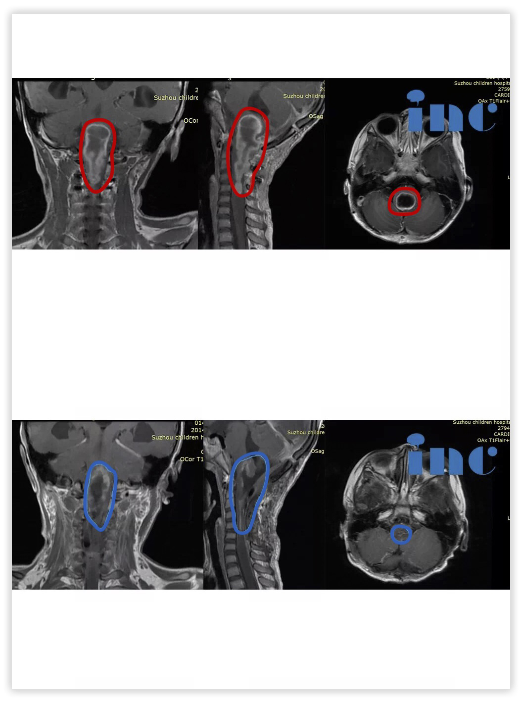 5岁女孩脊髓-脑干毛细胞星形细胞瘤图片