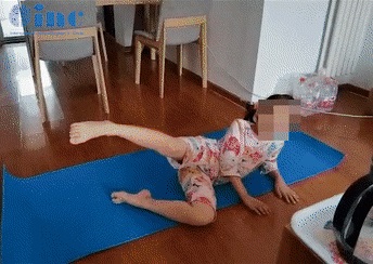 5岁女孩脊髓-脑干毛细胞星形细胞瘤术后图片