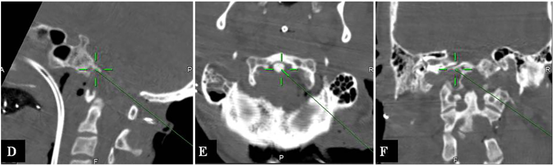 右侧内镜辅助远外侧经髁入路（EA-FLTA）切除颅颈交界处残余肿瘤图片