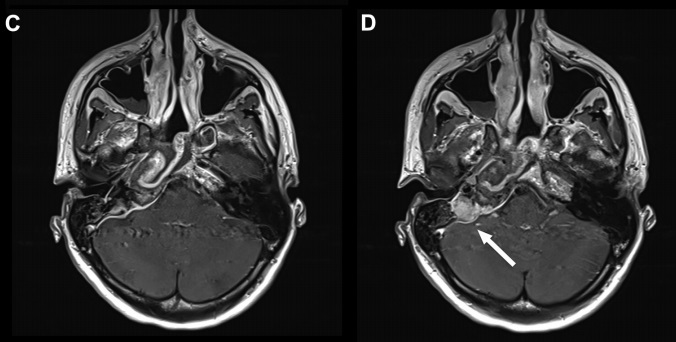 47岁女性岩尖区肉芽肿突发耳聋单鼻孔入路不开颅准确切除术后图片