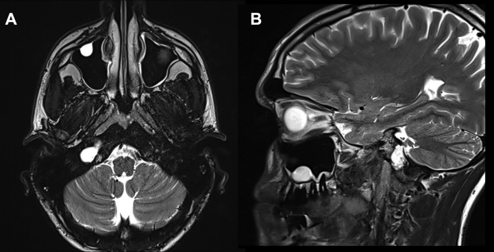 23岁法国男孩颅内颈静脉孔区肿瘤术前MR图片