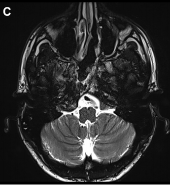 23岁法国男孩颅内颈静脉孔区肿瘤术后MR图片