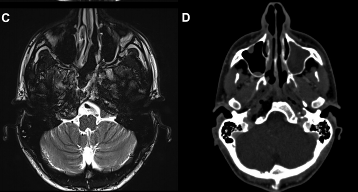 23岁法国男孩颅内颈静脉孔区肿瘤真实案例图片