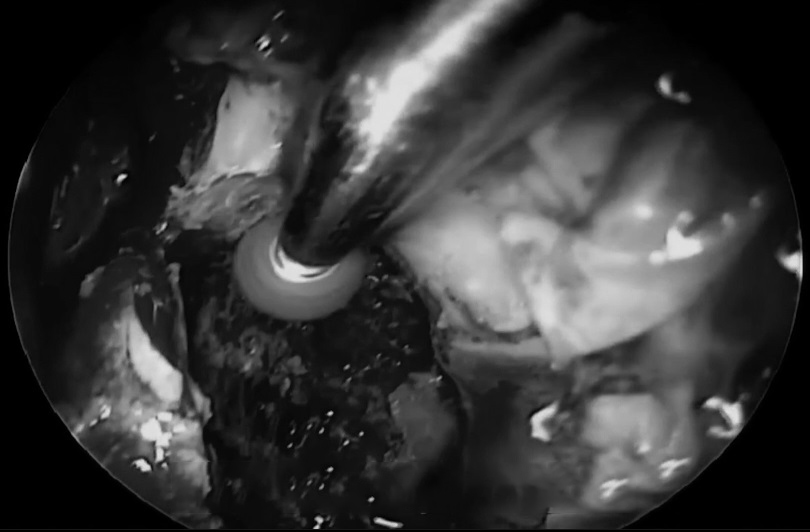 从肿瘤的顶部向下到下边缘，并向两侧的颈静脉方向延伸