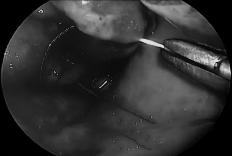 神经内镜手术图片