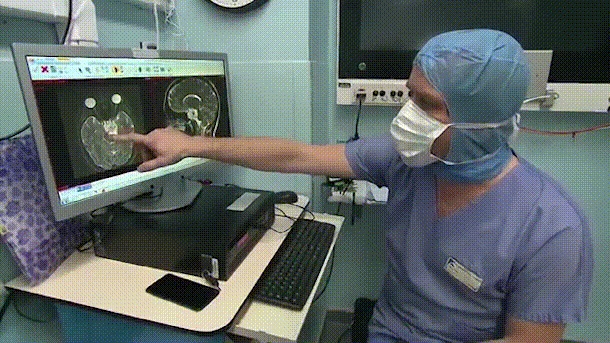 复杂脊索瘤长在斜坡、鞍区、侵犯海绵窦  　　不开颅如何顺利手术？