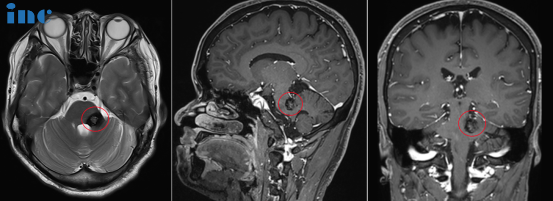 脑干海绵状血管瘤术前MRI图片