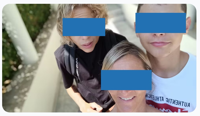 脊索瘤真实案例图片