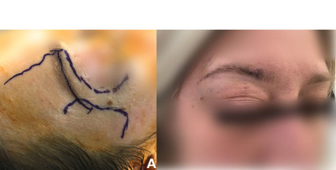 脑膜瘤术后图片