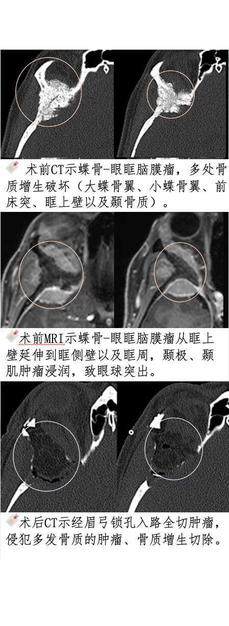 经眉弓锁孔巧切脑瘤真实案例图片
