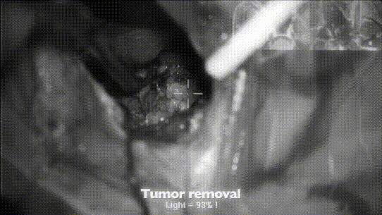 月状眶缘开颅术肿瘤取出图片