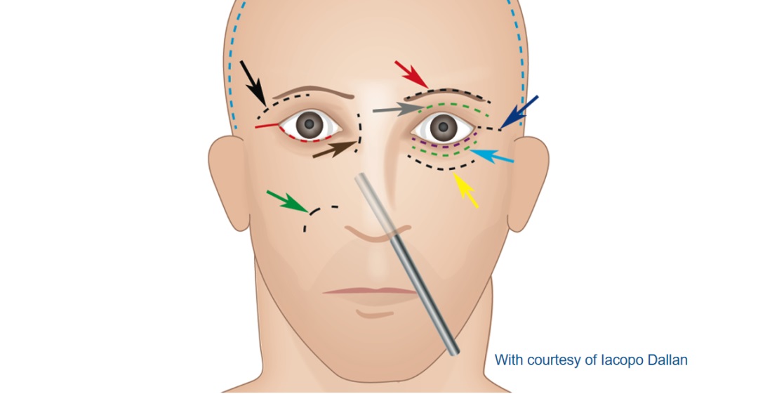 月状眶缘开颅术图片