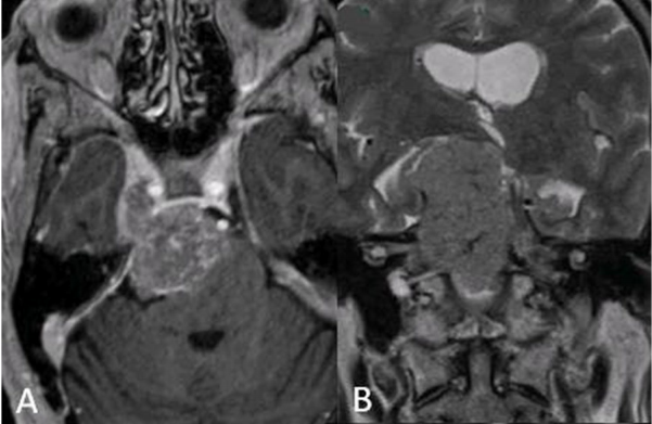岩斜区脑膜瘤术前图片